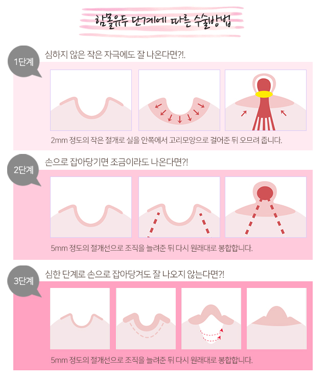 함몰유두수술 필요성에대해 관련 이미지 3