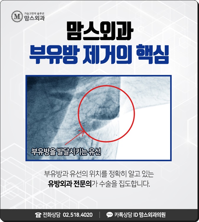 부유방수술 생각보다 간단하네! 관련 이미지 3