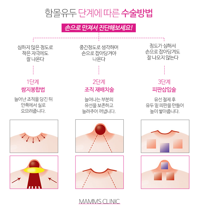 편평유두 이젠고민해결 관련 이미지 4