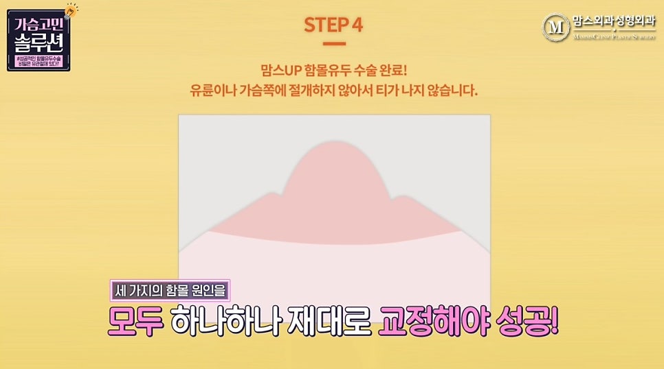 함몰유두수술의 성공을 위한 포인트는? 관련 이미지 15