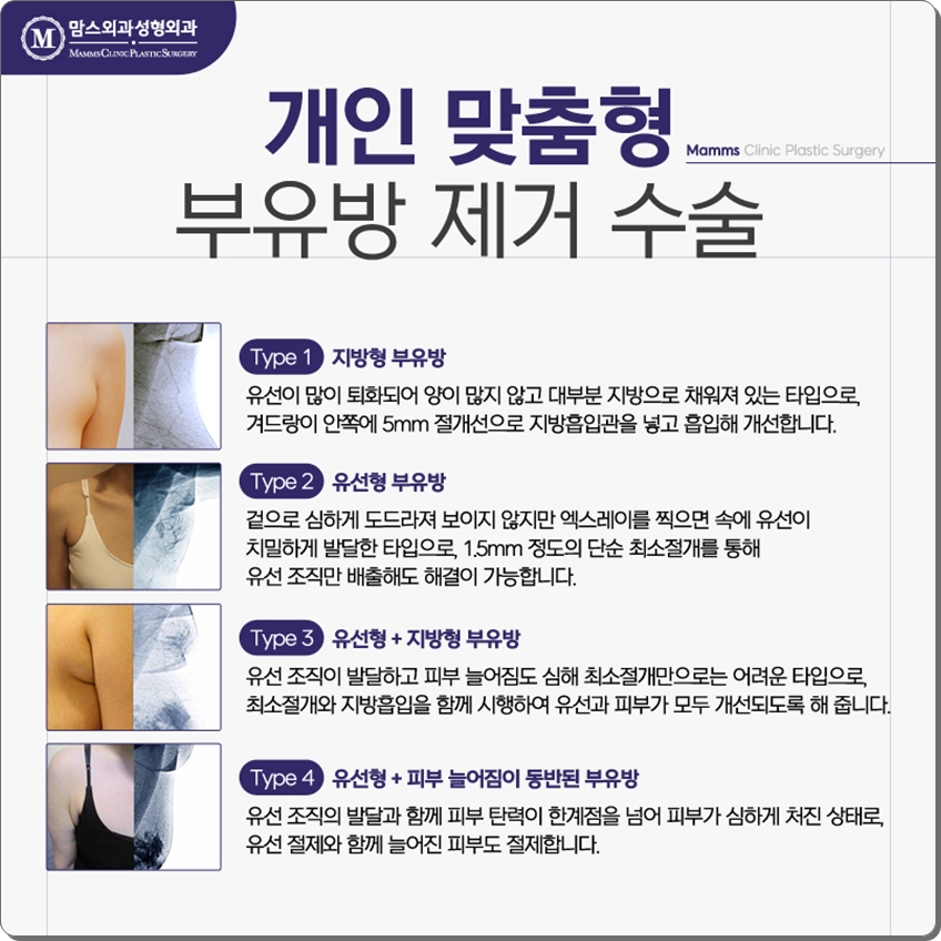 부유방제거수술 내게 맞는 것으로 관련 이미지 8