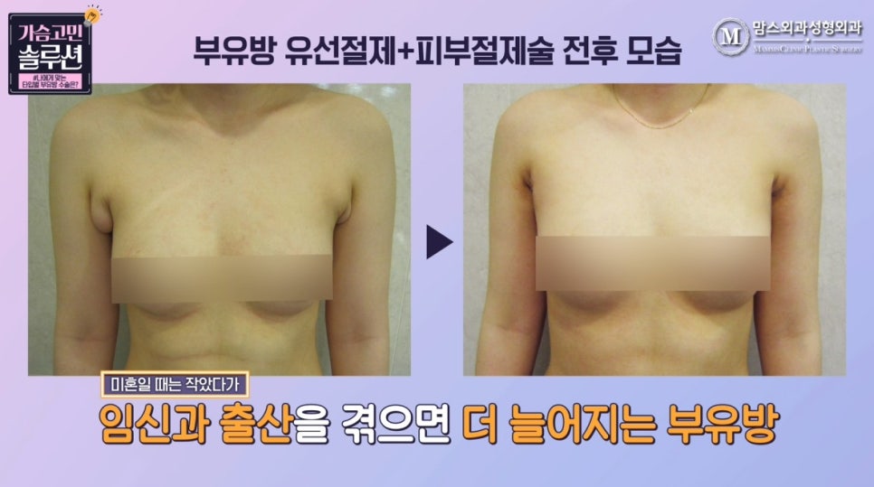 부유방제거수술 유형별 수술 방법은? 관련 이미지 12
