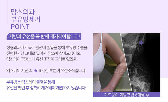 왼쪽겨드랑이통증 부유방의심! 관련 이미지 3