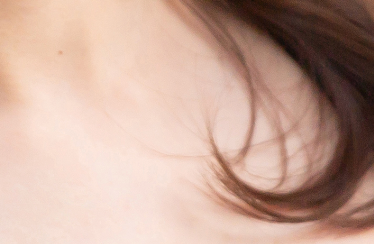 겨드랑이지방흡입 부유방제거는 병원과 전문의 선택이 정말 중요합니다 관련 이미지 16