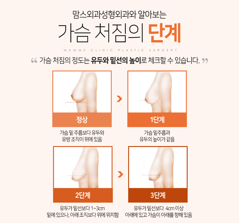 Key Points to Know Before Breast Lift Surgery! image 2