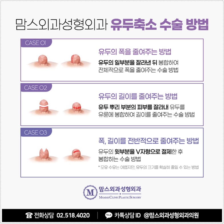 유두축소수술 적절하게 관련 이미지 6