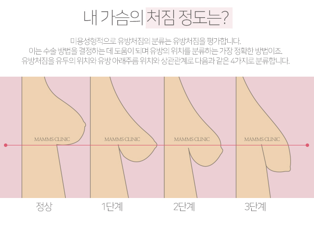 출산후처진가슴 아름다움회복 관련 이미지 3