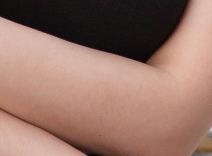 Areolar Surgery, Done Right in Just One Procedure! Toward Balanced Beauty image 22
