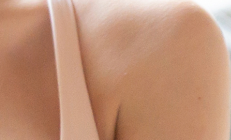 Personalized Accessory Breast Surgery Tailored to Your Axillary Skin Condition! image 18