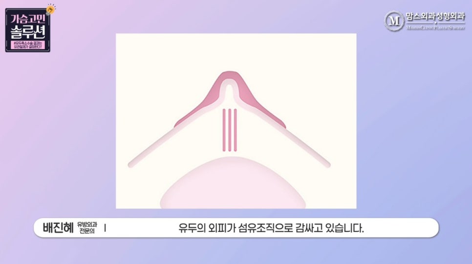 유두축소 수술, 유방외과 전문의가 말하는 결과를 결정하는 ‘이것’은? 관련 이미지 5