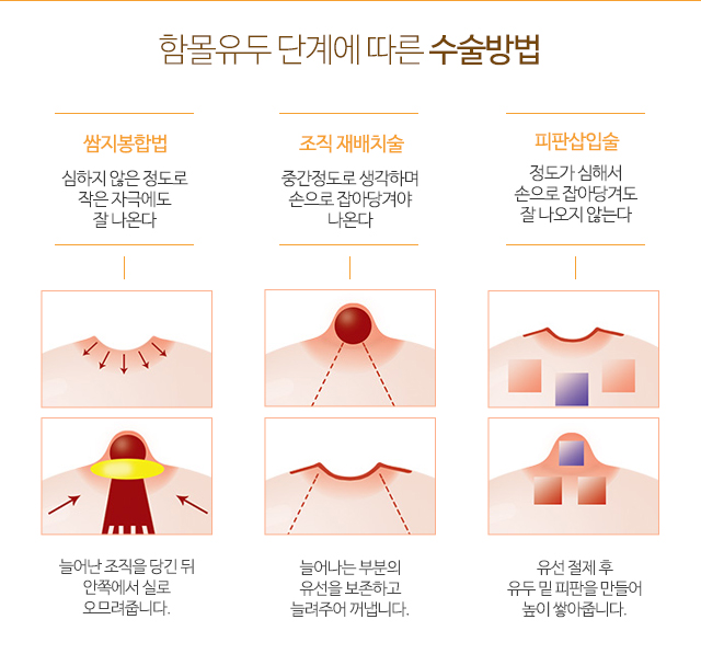 함몰유두교정 나에게적합하게 관련 이미지 4