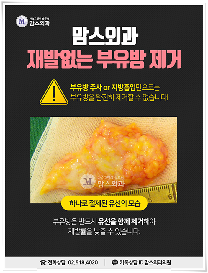 부유방제거수술비용 어느새 매끄럽게! 관련 이미지 4