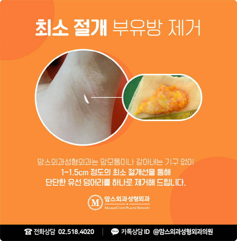 부유방통증 잘 살펴보세요! 관련 이미지 6