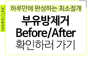 부유방제거수술비용 만큼중요한것 관련 이미지 5
