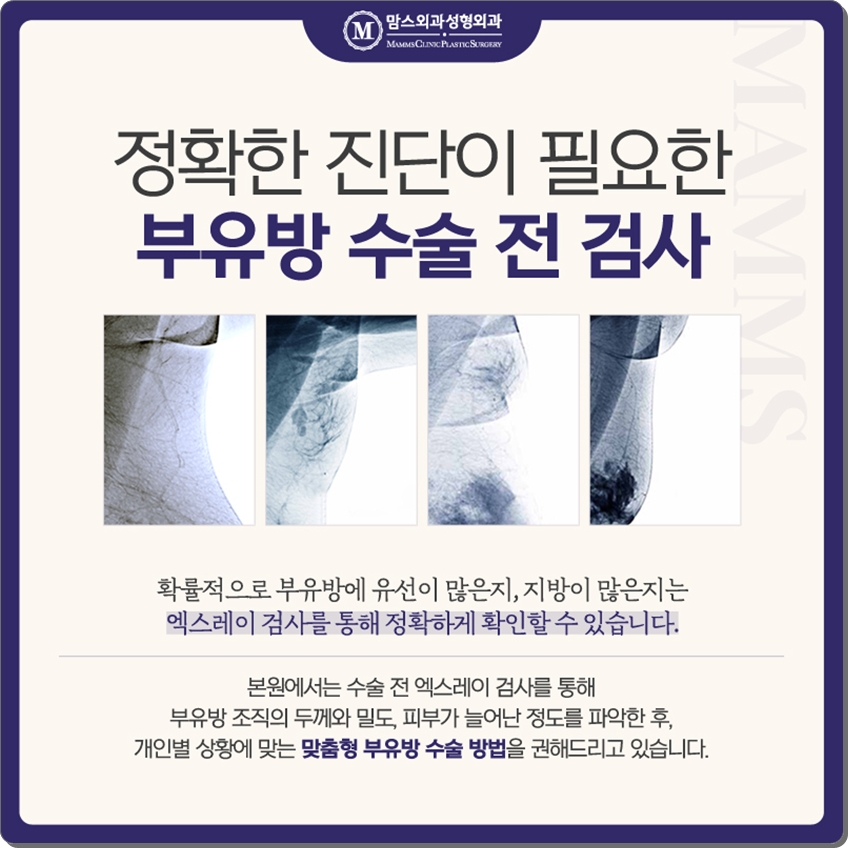 부유방제거수술 내게 맞는 것으로 관련 이미지 4