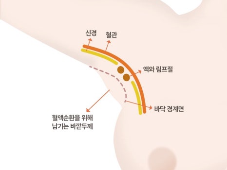 겨드랑이멍울병원 부유방, 유선만 제거하면 끝일까요? 관련 이미지 22