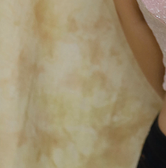 How Can a Systematic Management Method Help Fade Breast Reduction Scars? image 21