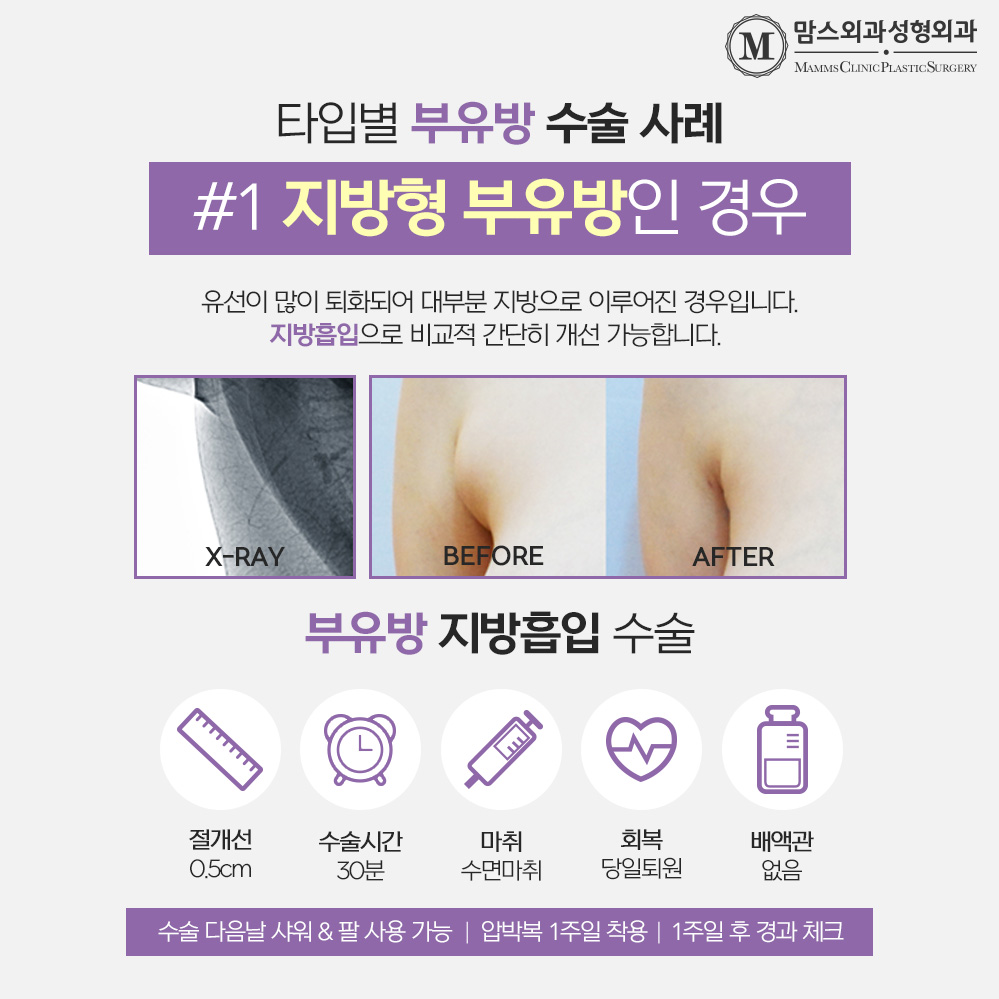 Why Should You Choose Accessory Breast Surgery Instead of Accessory Breast Injections? image 5