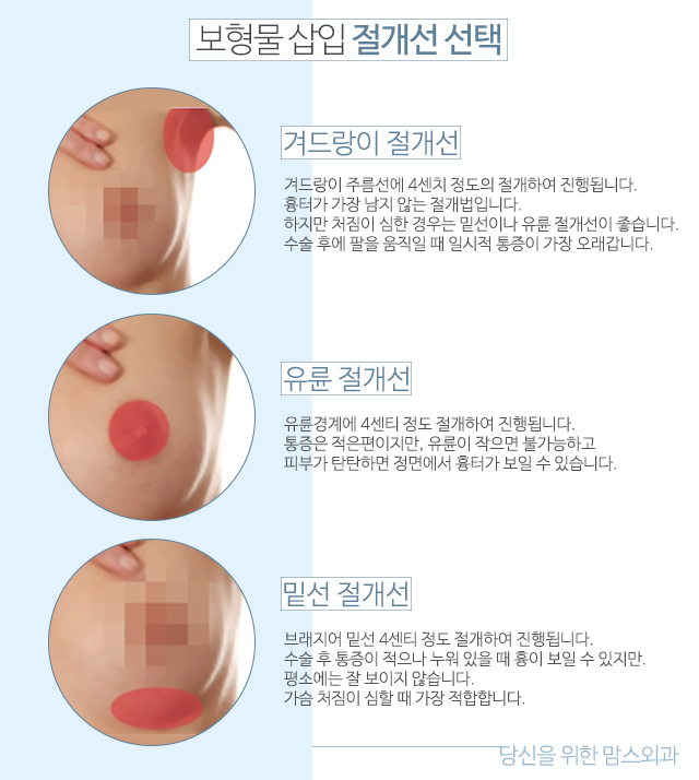 물방울가슴수술후기 보형물도확인하기 관련 이미지 3