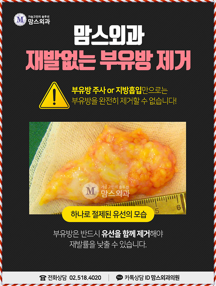 부유방수술 더 예쁜 라인을 위해! 관련 이미지 5