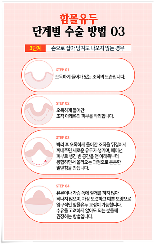 함몰유두 원인 아직까지 몰랐었지 관련 이미지 8