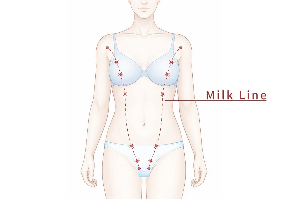 겨드랑이멍울병원 부유방, 유선만 제거하면 끝일까요? 관련 이미지 14