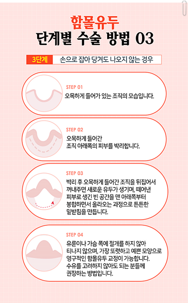 함몰유두수술후기 어떻게 변할까 관련 이미지 9