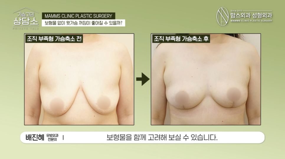 보형물 없이 윗가슴 꺼짐 해결될까? 가슴축소·거상 수술 전 필수 체크! 관련 이미지 8
