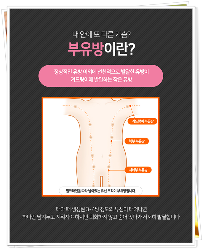 겨드랑이멍울 시선이 신경 쓰이죠 관련 이미지 3