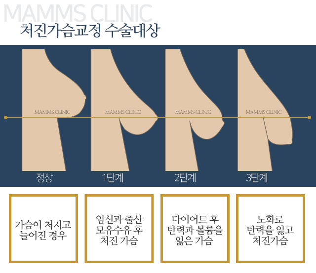 가슴처짐수술 안전하게아름답게 관련 이미지 2