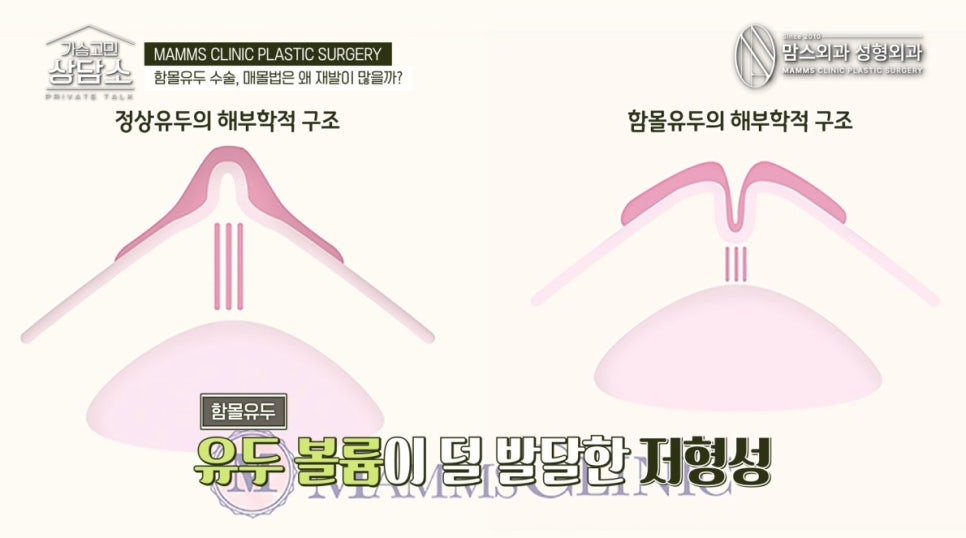 모유수유냐, 모양이냐! 나에게 맞는 함몰유두 수술법은? 관련 이미지 2