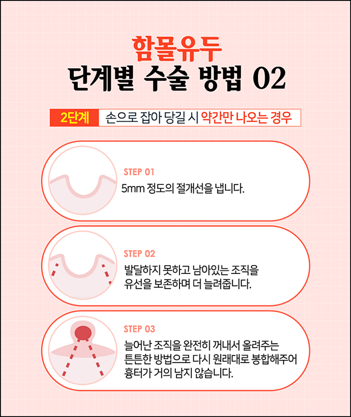 함몰유두교정 시선에 부담되니까 관련 이미지 7