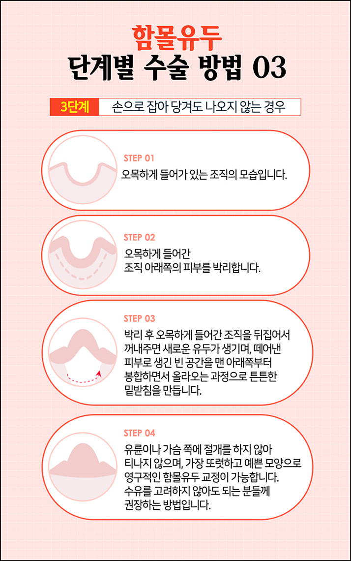 함몰유두교정 시선에 부담되니까 관련 이미지 8