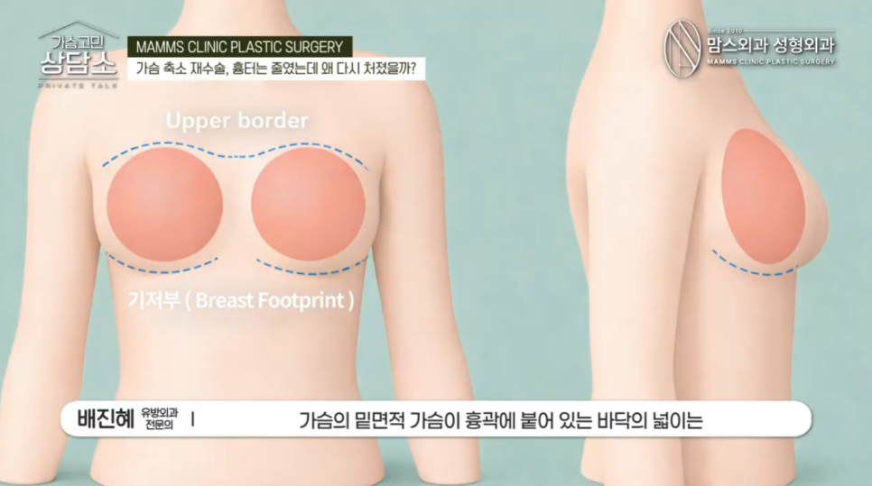 가슴축소재수술, 수직절개 후 다시 처진다면? 관련 이미지 4