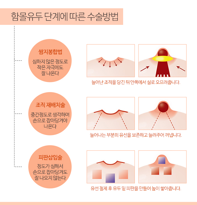 함몰유두분비물 방치마세요 관련 이미지 4