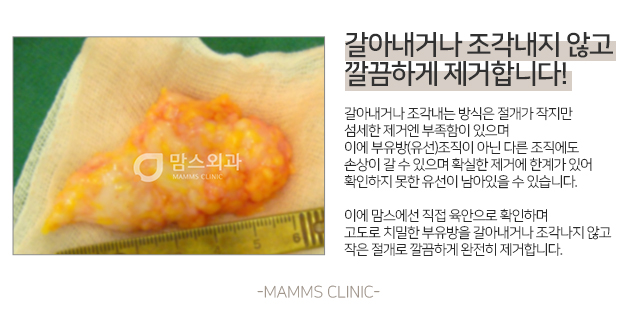 부유방제거수술 한번에깔끔하게 관련 이미지 4