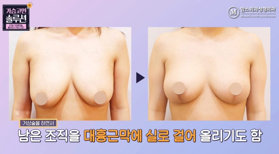가슴 거상확대술, 줄이면서 키운다고요? 관련 이미지 12