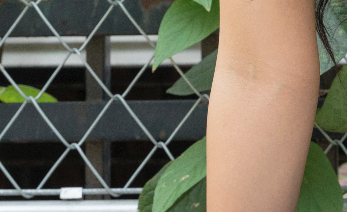 Effectively Improve Postpartum Sagging Breasts with a J-Incision! image 21