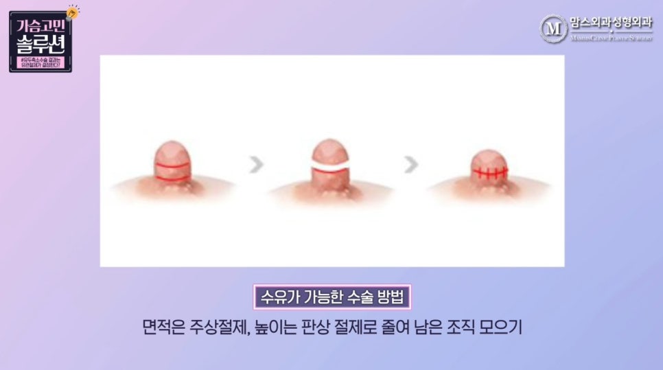 유두축소 수술, 유방외과 전문의가 말하는 결과를 결정하는 ‘이것’은? 관련 이미지 6