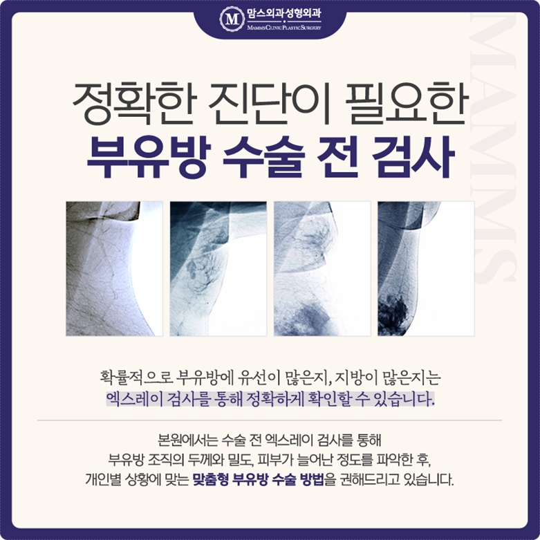 부유방지방흡입 무엇을 기준으로? 관련 이미지 6