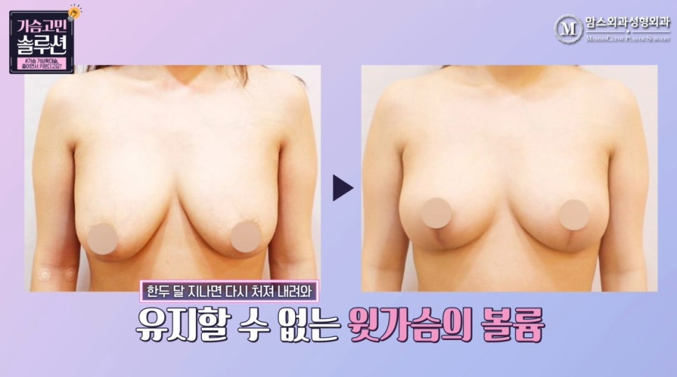 가슴 거상확대술, 줄이면서 키운다고요? 관련 이미지 13