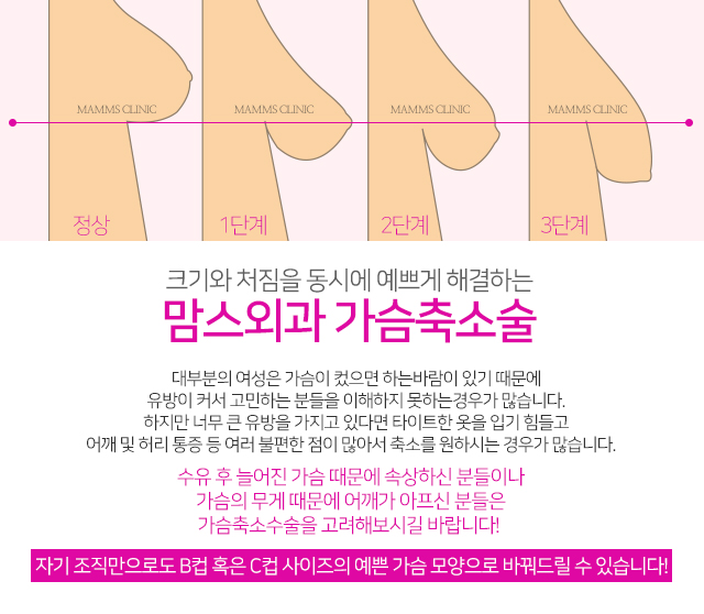 가슴처짐증 말못할고민 관련 이미지 2