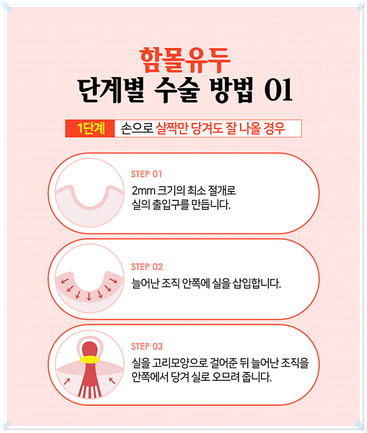 함몰유두수술가격 단계별로 생각해보자! 관련 이미지 7