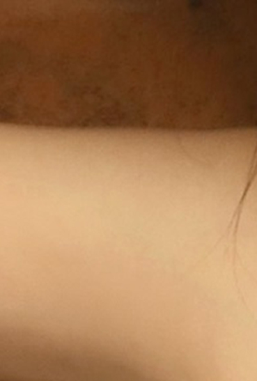 겨드랑이멍울을 떼어낼 방법을 찾고 있나요? 관련 이미지 25