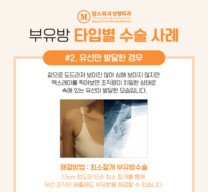 겨드랑이볼록 부유방 덜어내고 편안한 일상으로! 관련 이미지 3