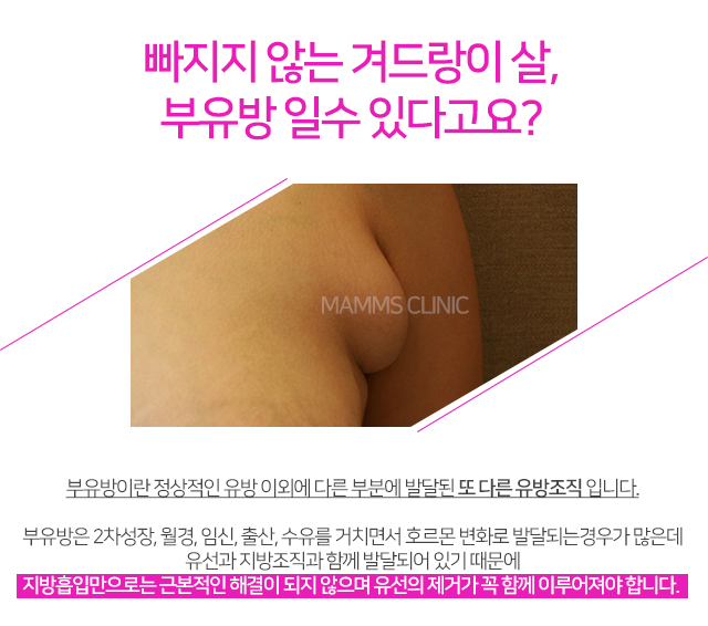 부유방제거수술 한번에해결 관련 이미지 2