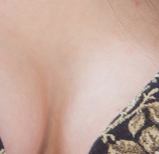 부유방제거수술 생각을 다지고 관련 이미지 24