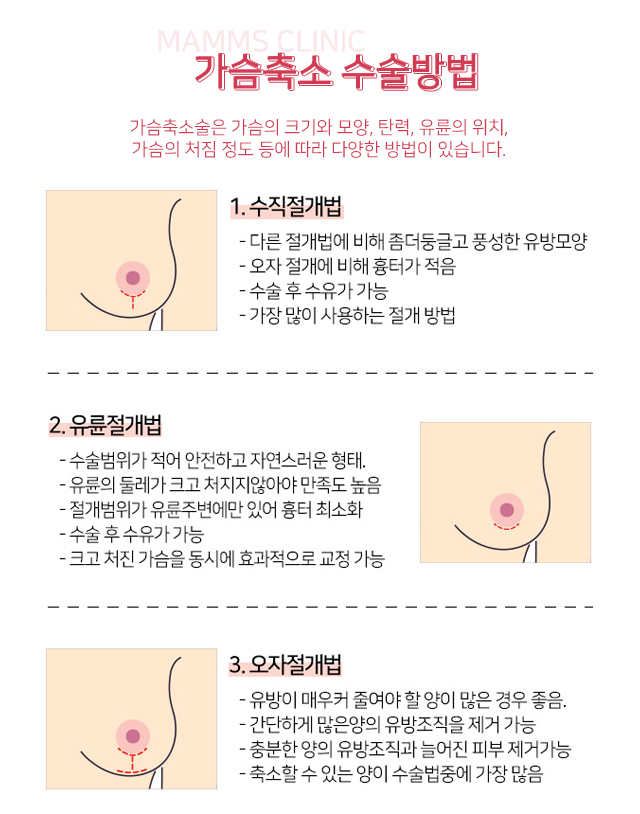 가슴축소수술후기 나에게맞게 관련 이미지 4