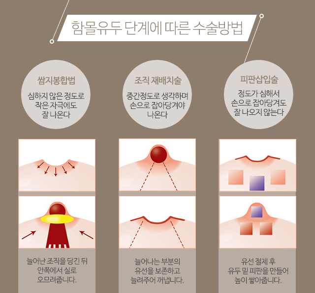 함몰유두교정기 충분하지않다면 관련 이미지 4