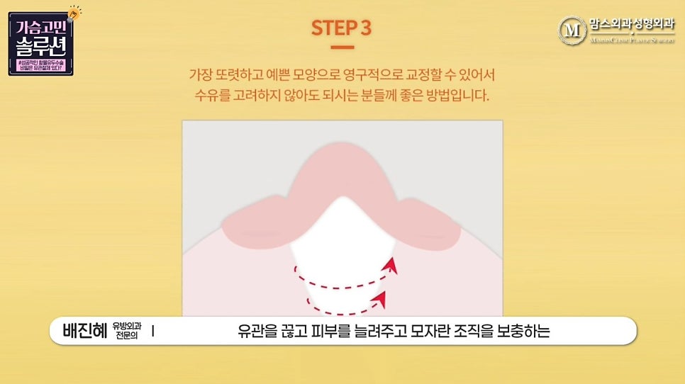 함몰유두수술의 성공을 위한 포인트는? 관련 이미지 14